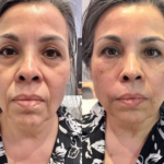 Facial PRP: Unlock Remarkably Youthful Skin with This Powerful, Regenerative Treatment